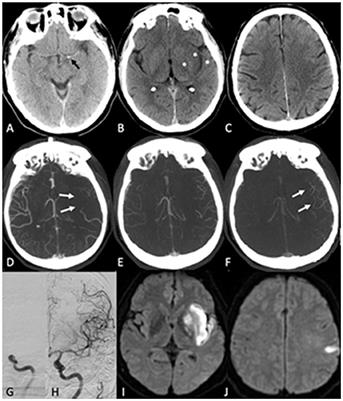 Time-Based Decision Making for Reperfusion in Acute Ischemic Stroke